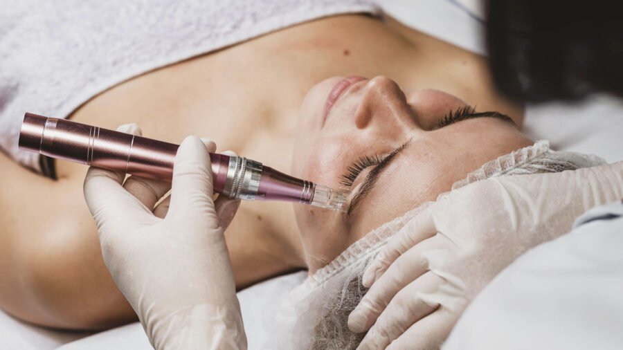 Microneedling